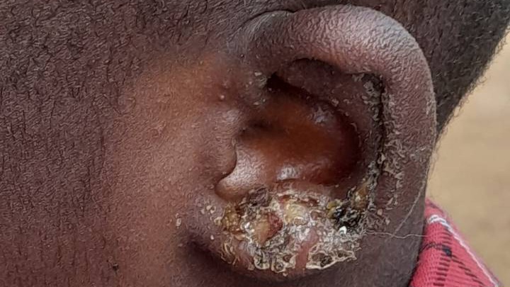 Urgent Appeal: Help Us Fight an Outbreak of Ear Infections